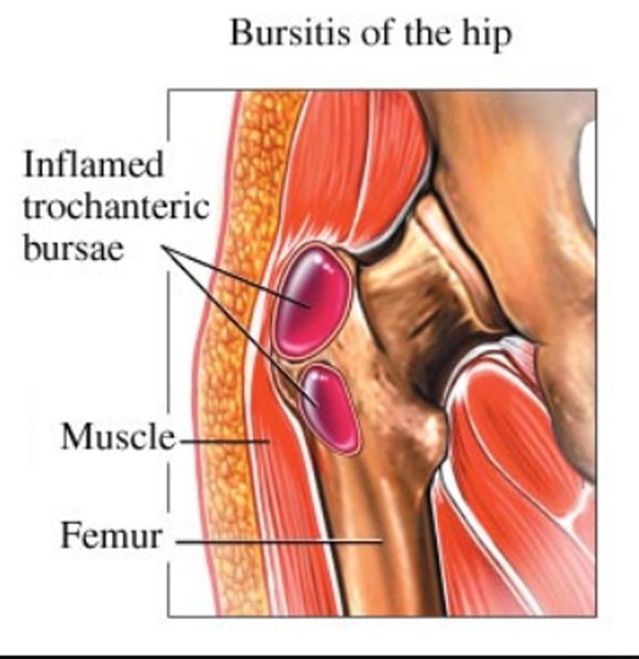 Trochanteric bursitis