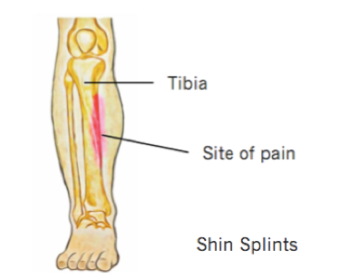Understanding Shin Splints: Symptoms, Causes & Treatment