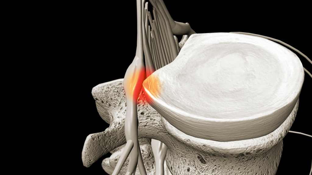 Recovering From a Disc Injury: What You Need to Know
