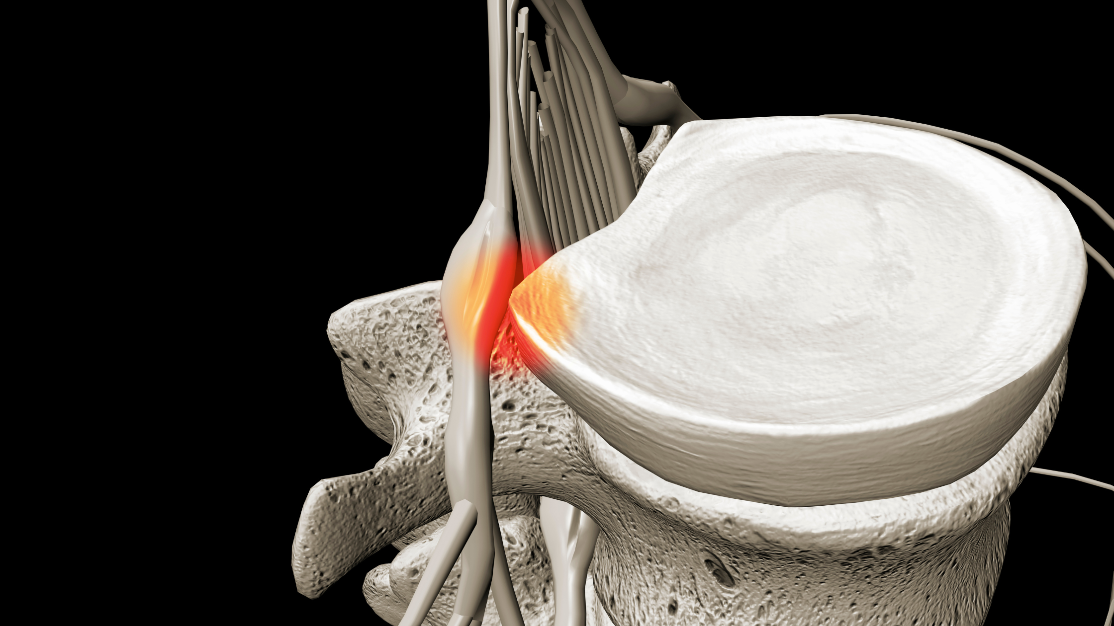 disc injury physiotherapy
